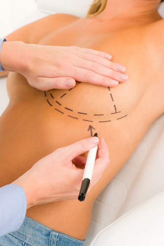 Breast Augmentation Revision Surgery Recovery